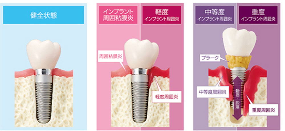 インプラント歯周炎